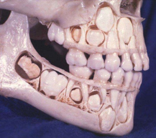 Baby_Teeth_Exposed