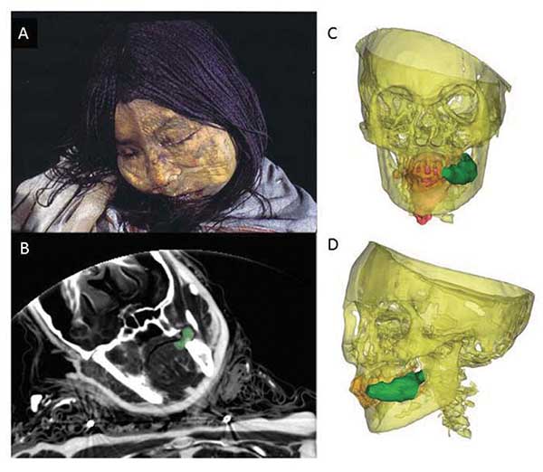 Girl Frozen500 Years