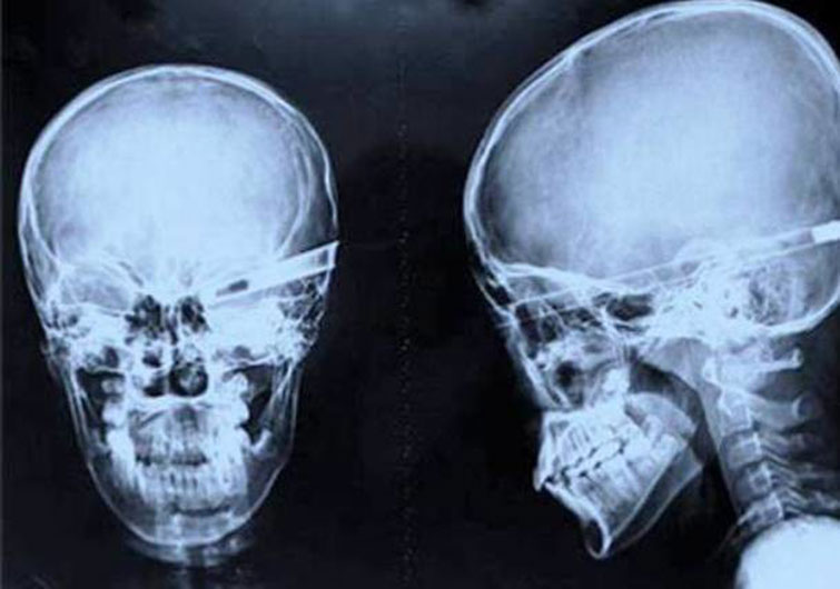 crazy xrays