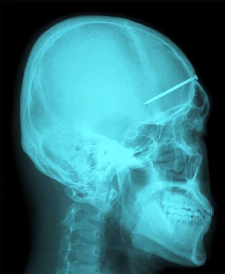 crazy xrays