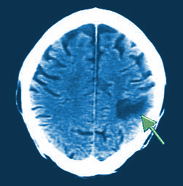 beauty parlor stroke