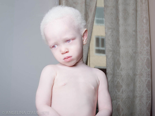 Albino People