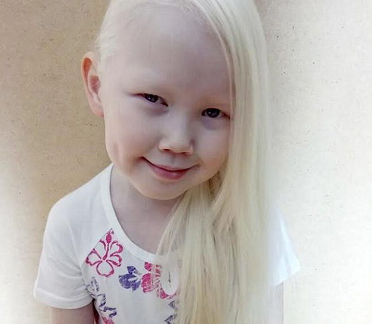 albino girl