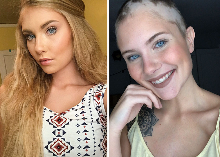 alopecia senior photoshoot