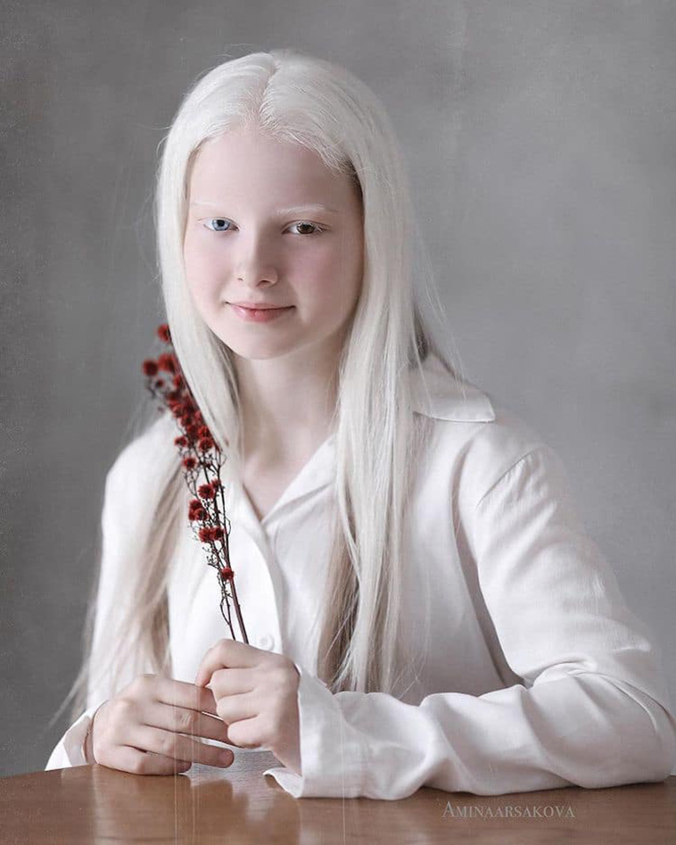 girl with albinism