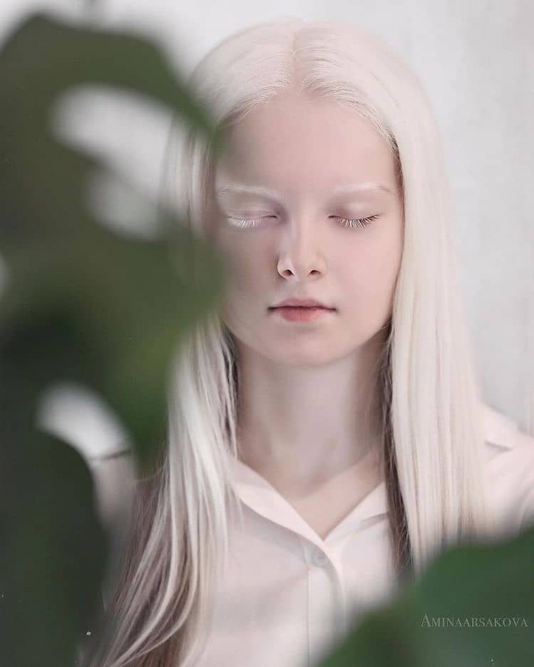 Albinism and Heterochromia