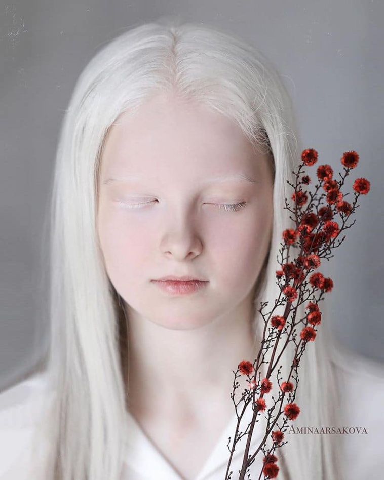 girl with albinism