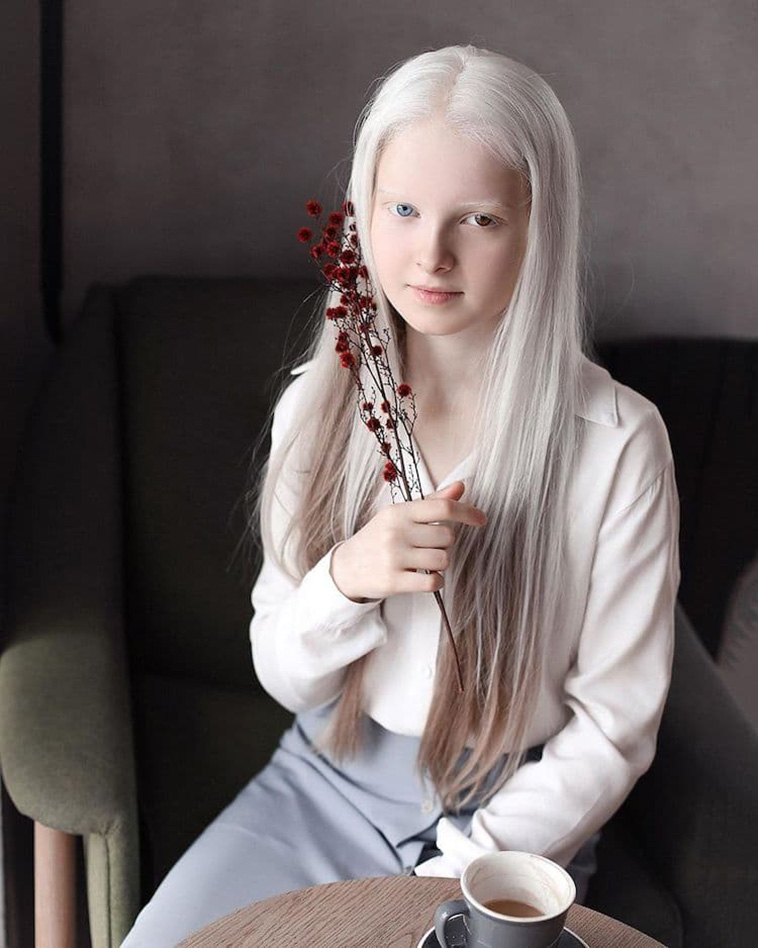 girl with albinism