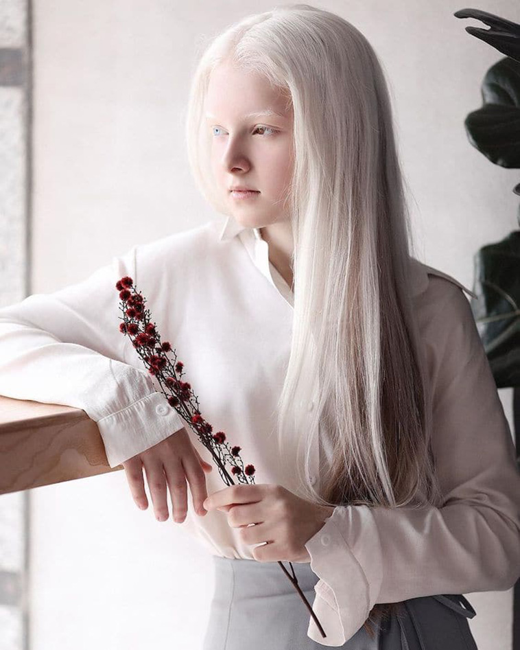 Albinism and Heterochromia