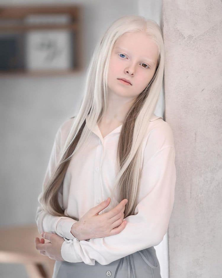 Albinism and Heterochromia