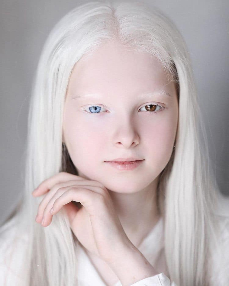 Albinism and Heterochromia