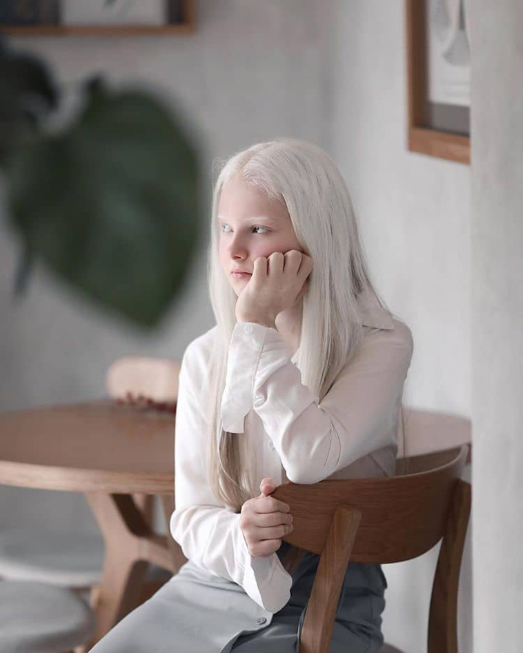 Albinism and Heterochromia