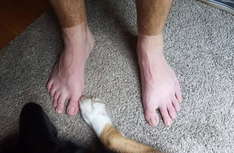 funny sunburned