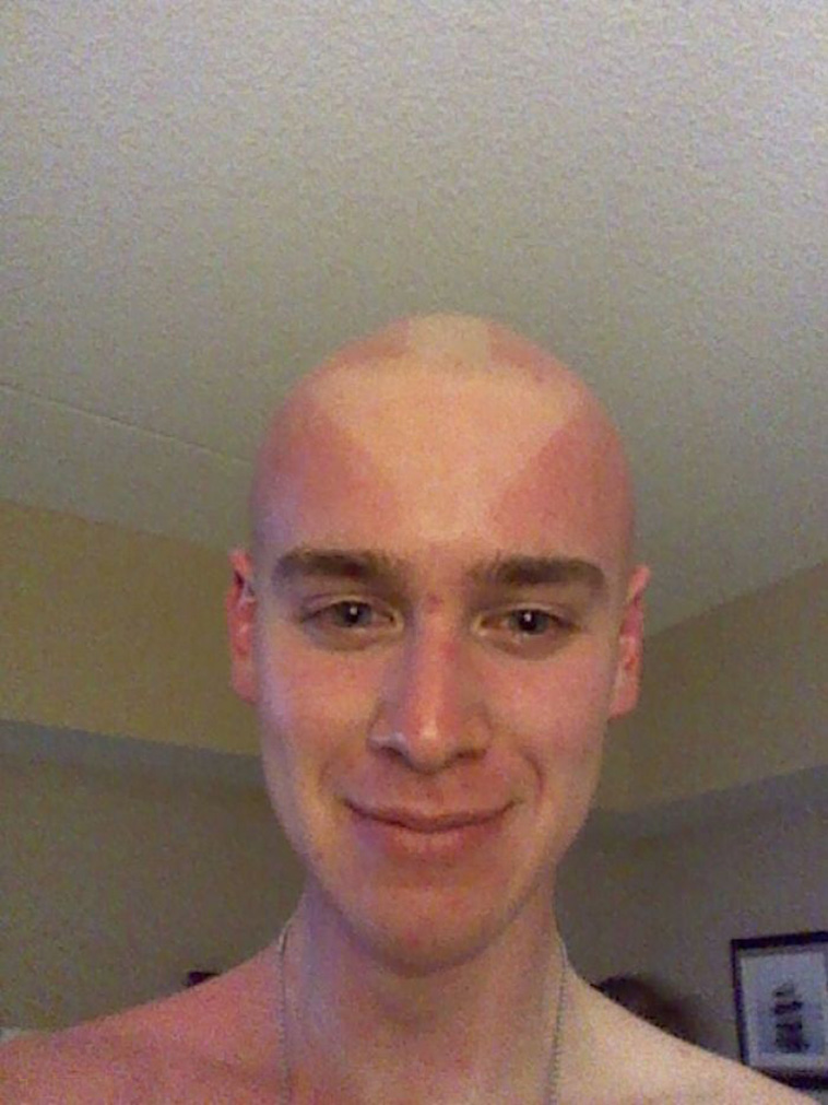 funny sunburned