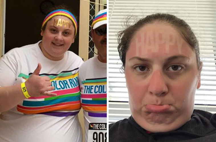 funny sunburned