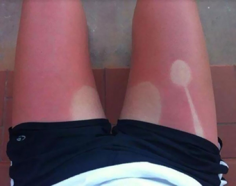 funny sunburned