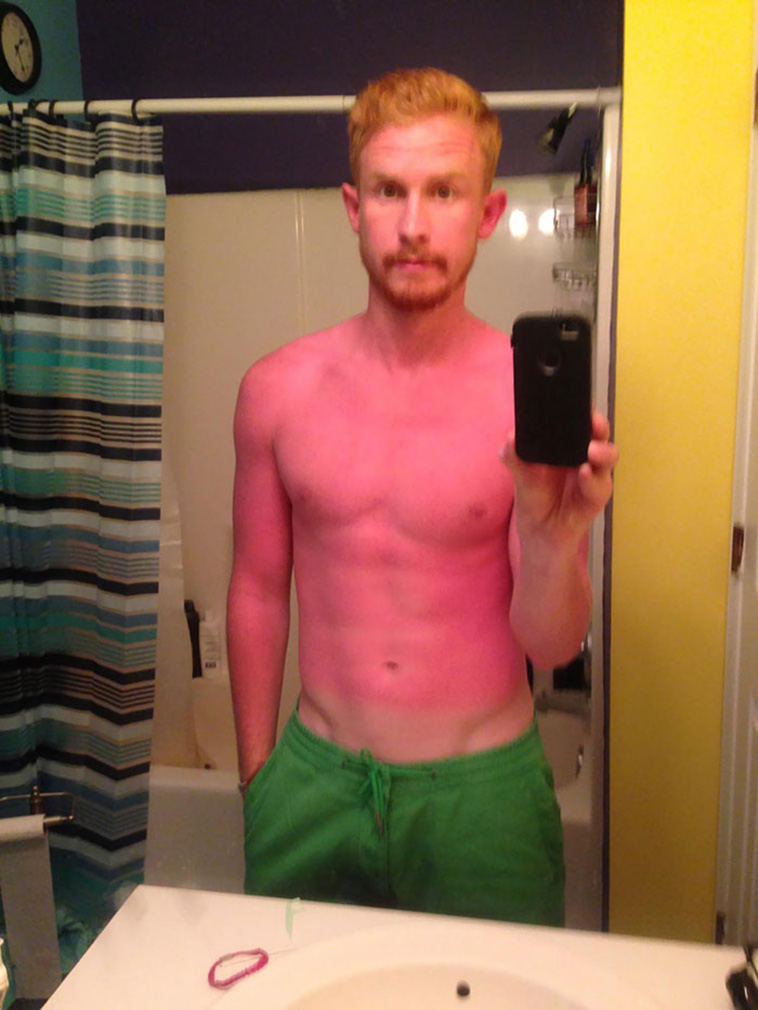 funny sunburned