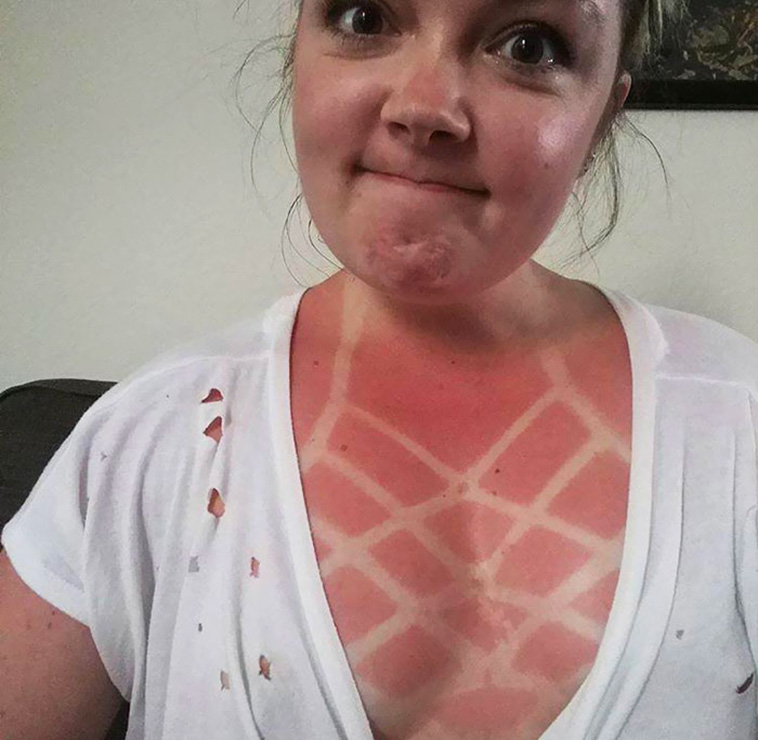 funny sunburned