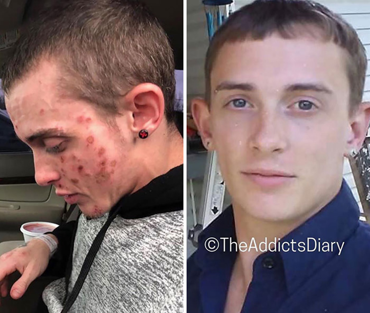 drug addiction before after
