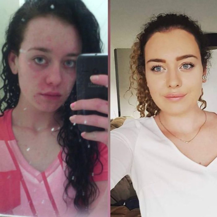 drug addiction before after