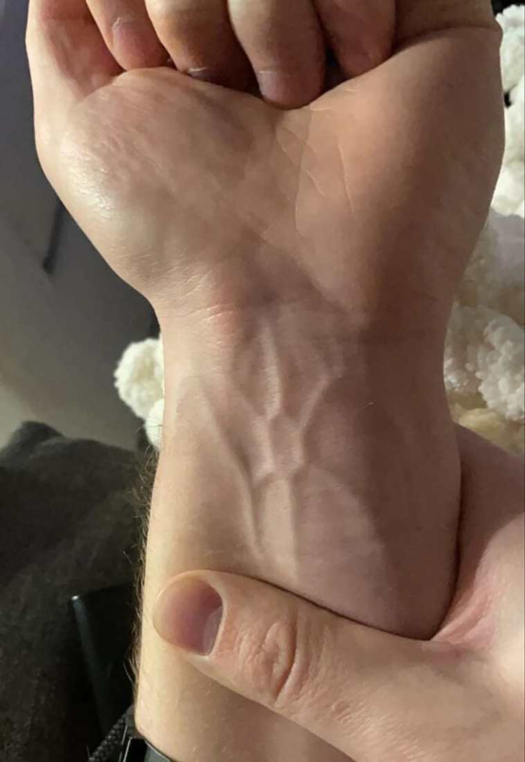 rare genetics