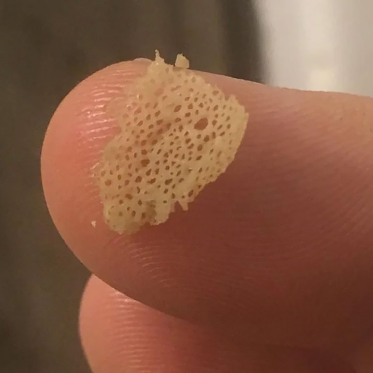 trypophobia